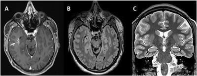 Myoclonic Jerks and Schizophreniform Syndrome: Case Report and Literature Review